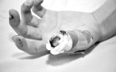 Ibagué suma siete lesionados por pólvora durante la celebración de Navidad