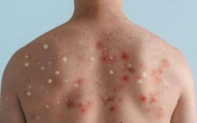 Autoridades investigan causas de la muerte de contagiado con viruela símica en Ibagué